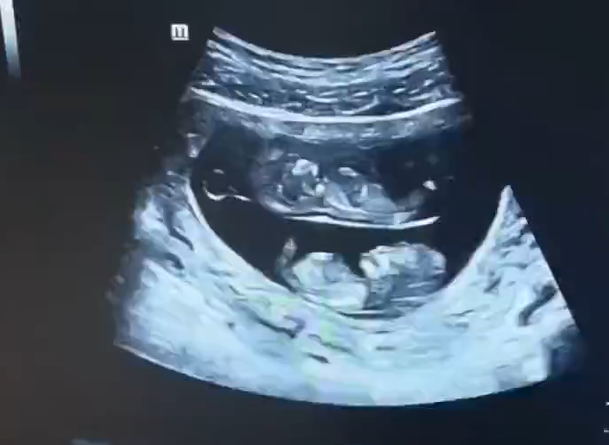 孕婦做B超拍到上下鋪寶寶 網友：真·睡在我上鋪的兄弟