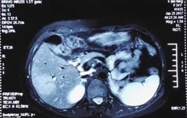 女子3次試管嬰兒終于懷上卻查出癌癥，面對巨大選擇難題該怎么辦？