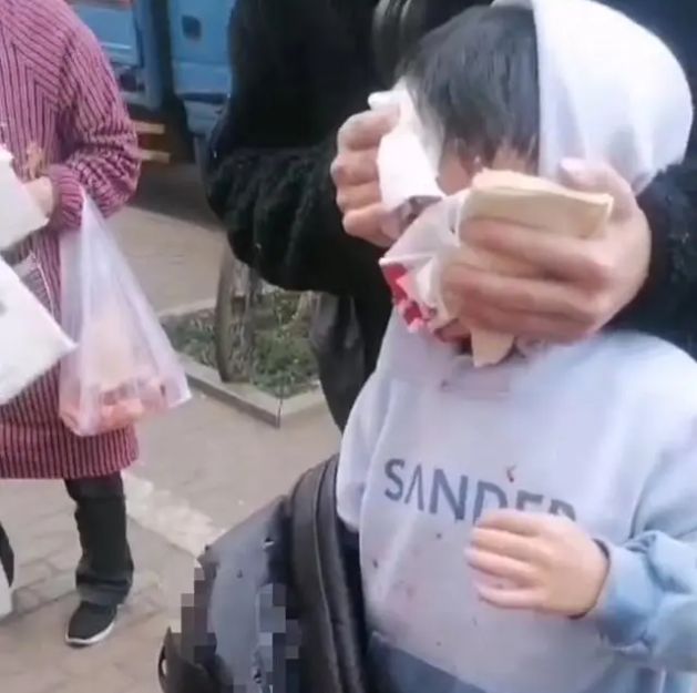 8歲男童遭狗撲咬 臉上縫了90多針