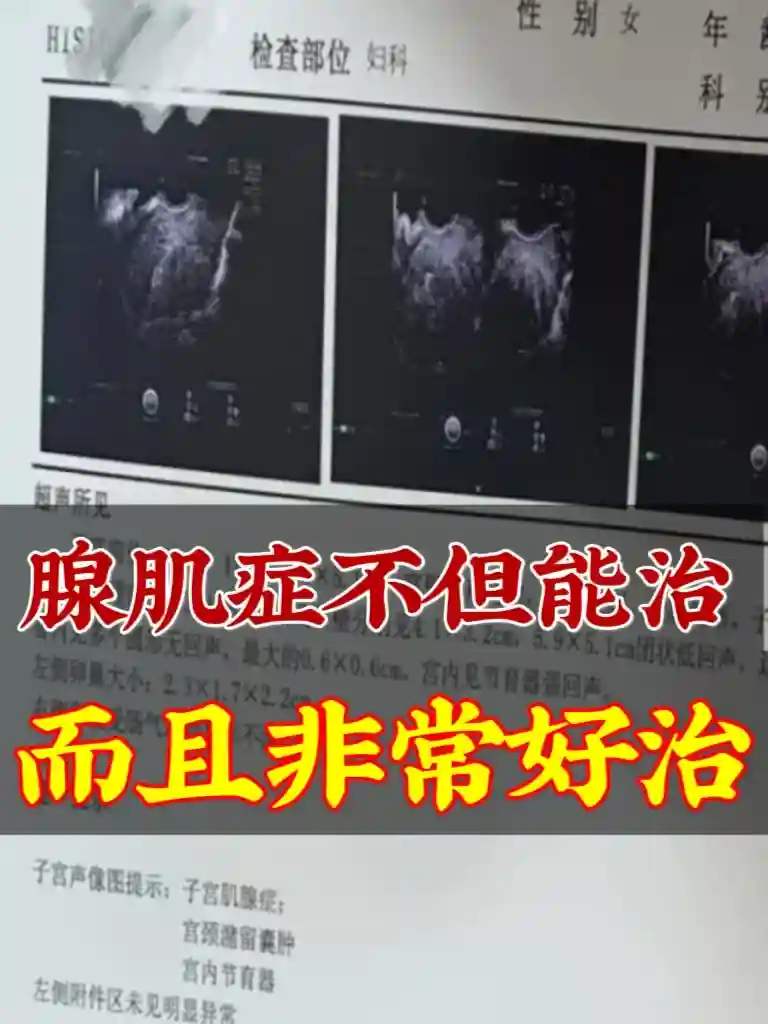 腺肌癥不但能治，而且非常好治