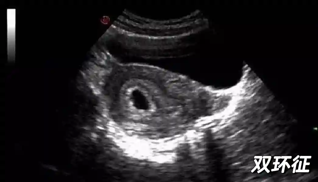 每天只學一點點 | 早孕期超聲檢查（1）