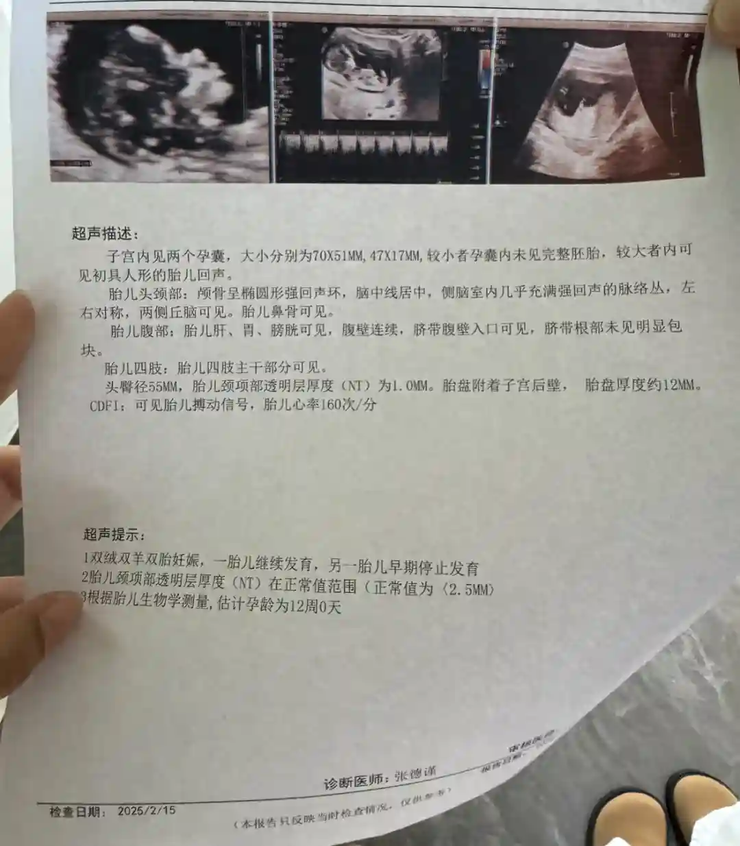 囊胚移植分裂雙絨雙羊胎停一個