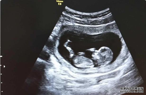 海口代懷生兒子 海口試管嬰兒醫院排名參考 ‘孕囊兩個數據一樣,可以另一個大男孩女孩’