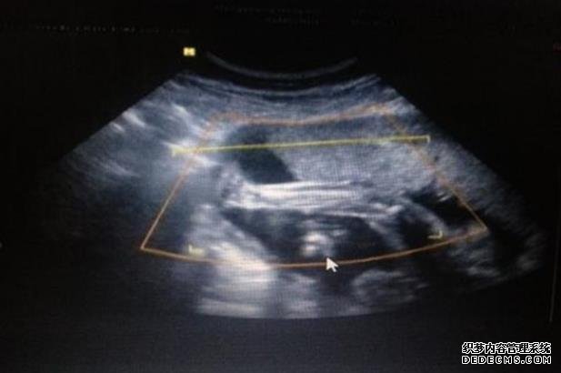 甘肅代孕母 2022年甘肅試管嬰兒哪家醫(yī)院好? ‘五周彩超17*11*18是男是女’