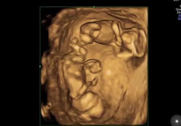 西北婦幼做試管嬰兒成功率高不高？一次試管多少錢？