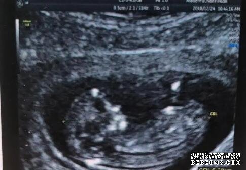 石家莊供卵代孕電話 石家莊二院試管嬰兒成功率有多大?2022年試管成功率參考 ‘四維單上怎么看男女寶寶’