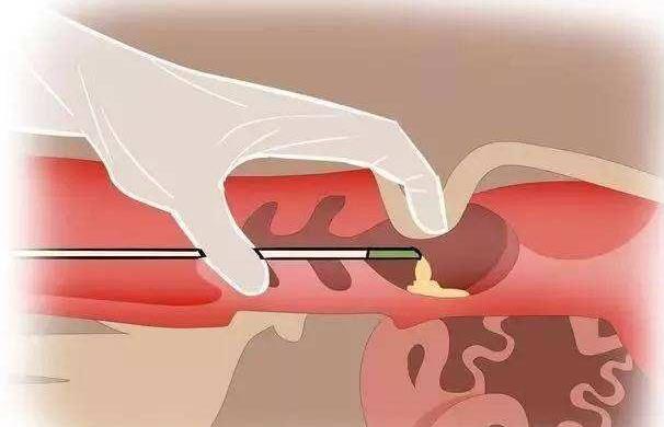 廣州借腹生子代孕 廣州中山孫逸醫(yī)院試管價錢試管嬰兒的錢花在哪？ ‘彩超常規(guī)單怎么知道男女’