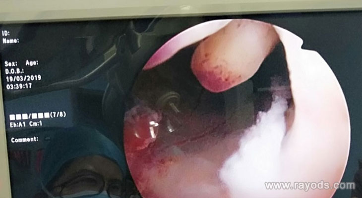 不同情況女性做宮腔鏡檢查的危害不一樣