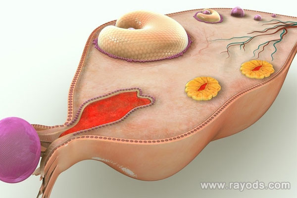 巧克力囊腫會導(dǎo)致不孕
