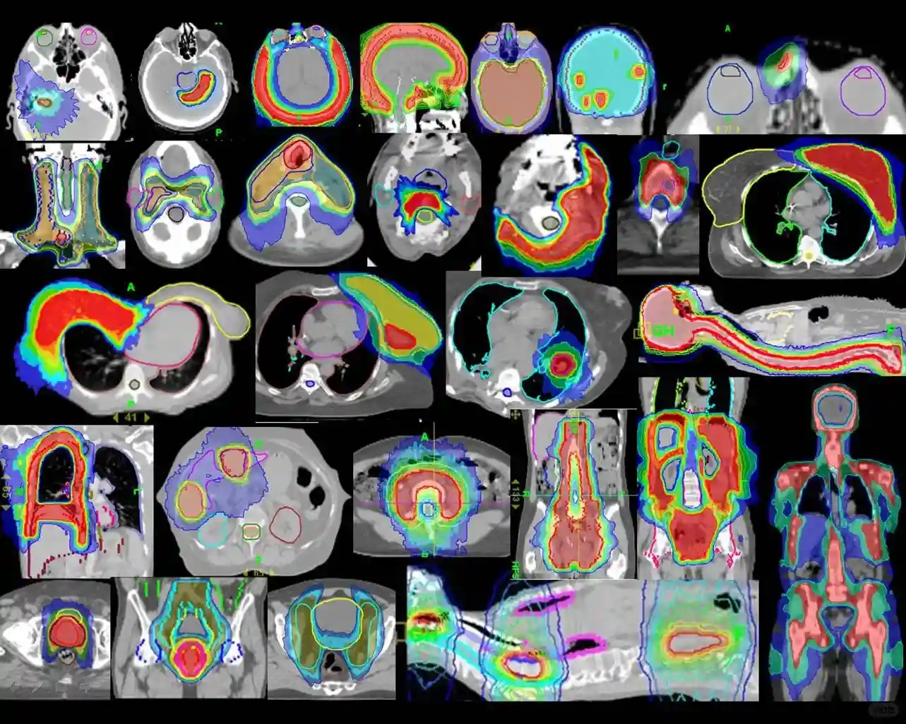 驚艷腫瘤界的技術-TOMO刀，又稱托姆刀
